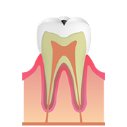 C1《エナメル質のむし歯》
